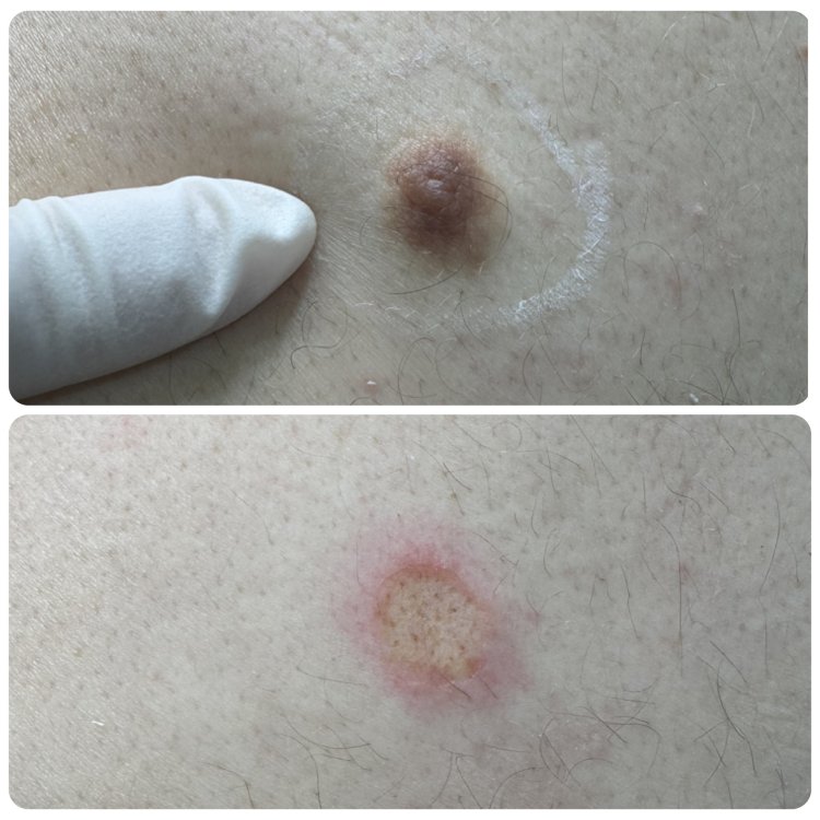 CO2 Laser Acne Scar Treatment