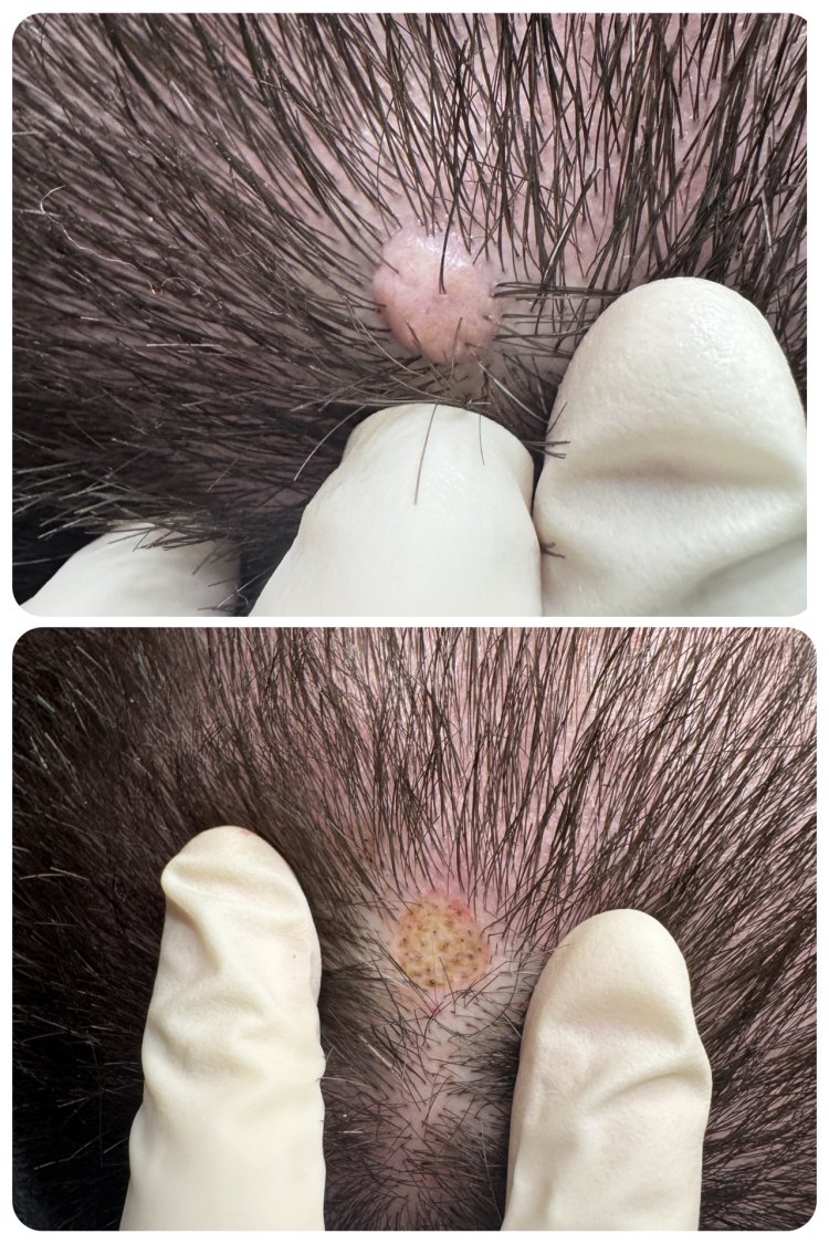 CO2 Laser Pore Reduction