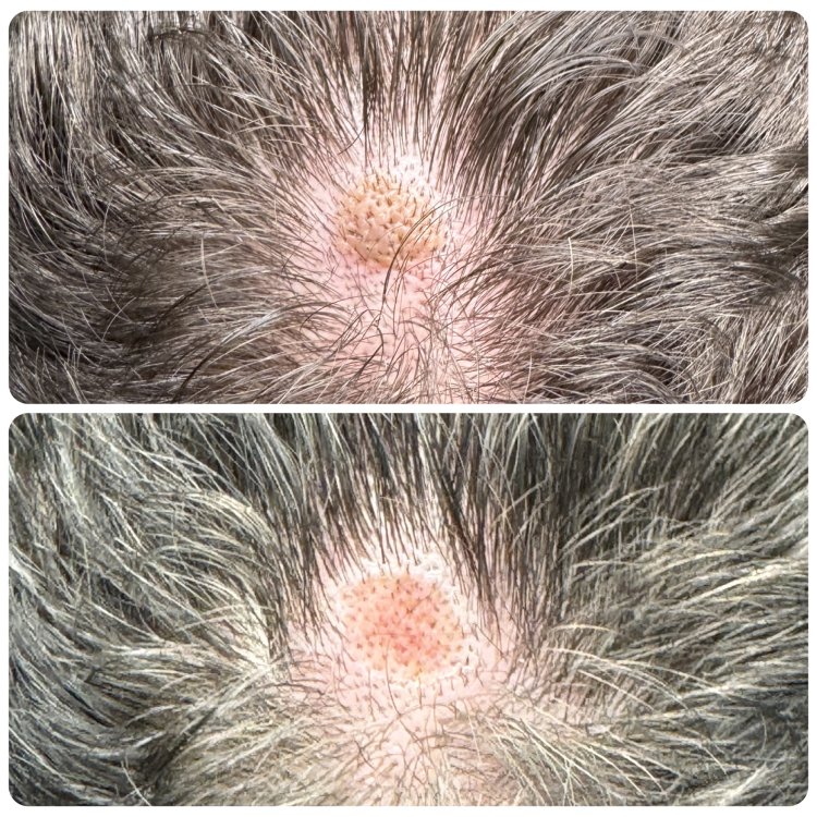 CO2 Laser Skin Renewal