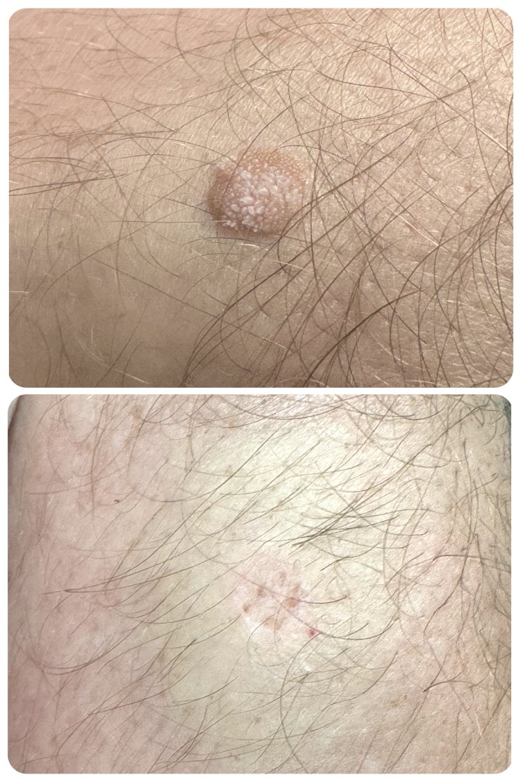 CO2 Laser Treatment Progress