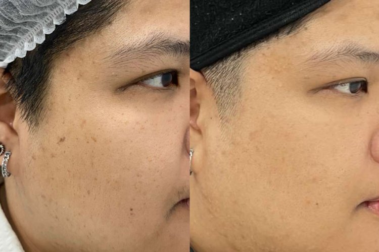 CO2 Laser Procedure at Dr. Pang Skin Clinic