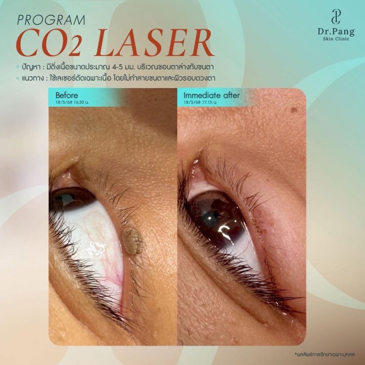 CO2 Laser Treatment in Progress