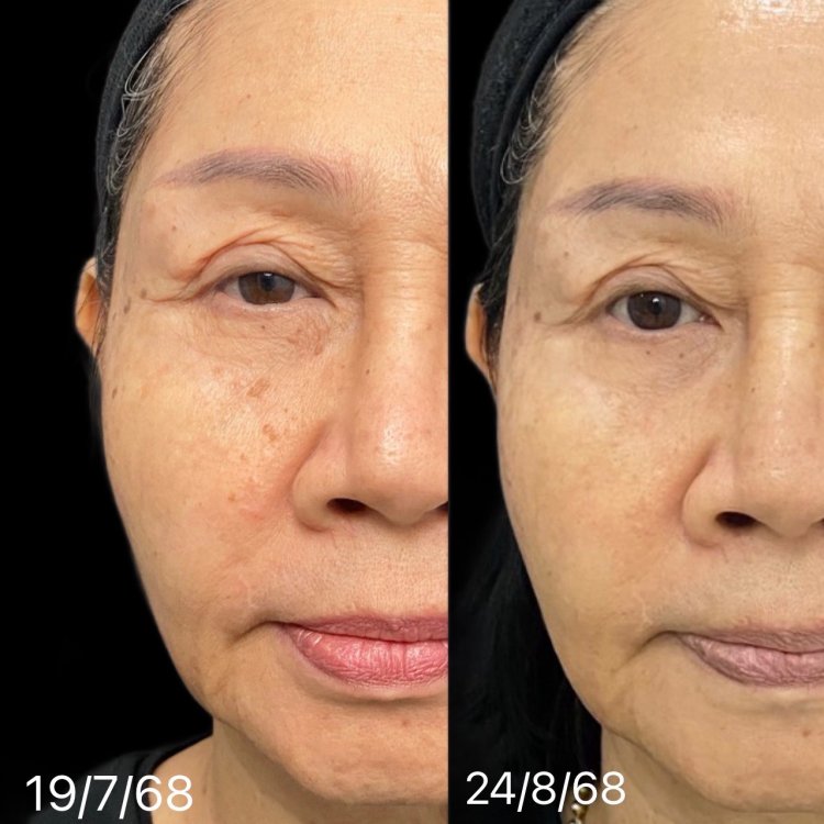 CO2 Laser Before After