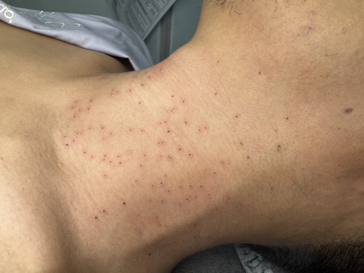 CO2 Laser Treatment Success