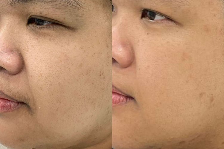 CO2 Laser Technology - Fractional Skin Resurfacing