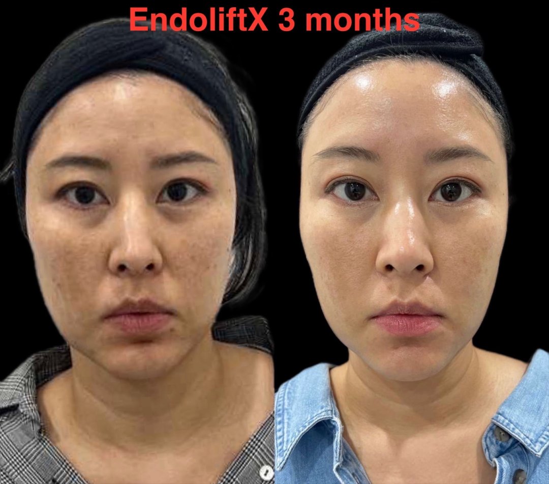 Endolift X Before After Result 2