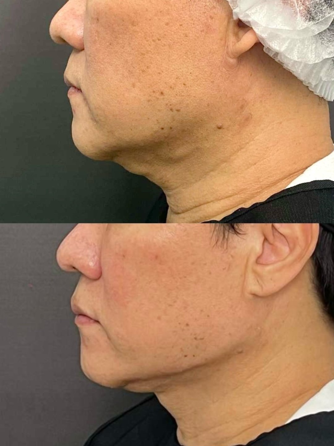 Endolift X Before After Result 3