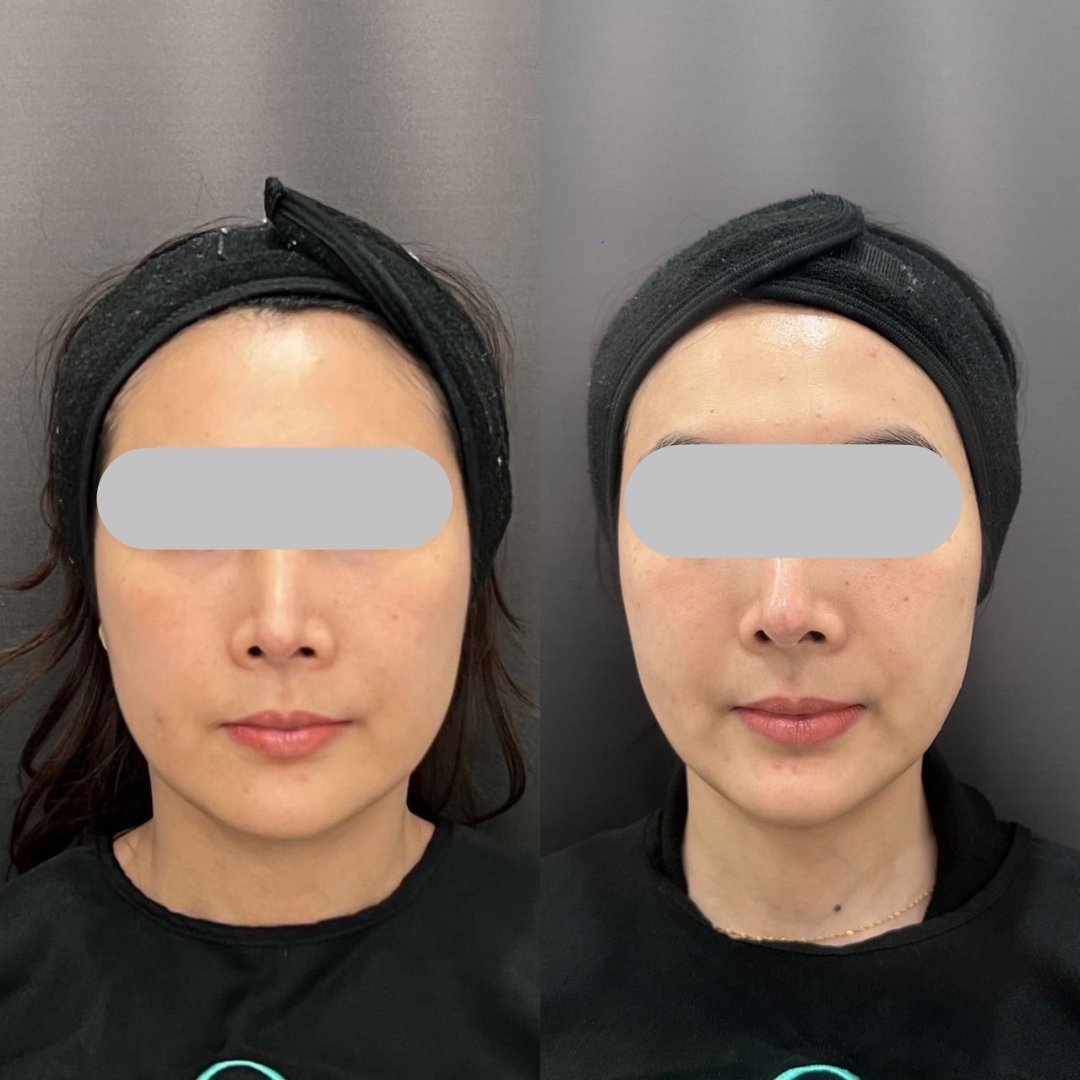 Endolift X Before After Result 4