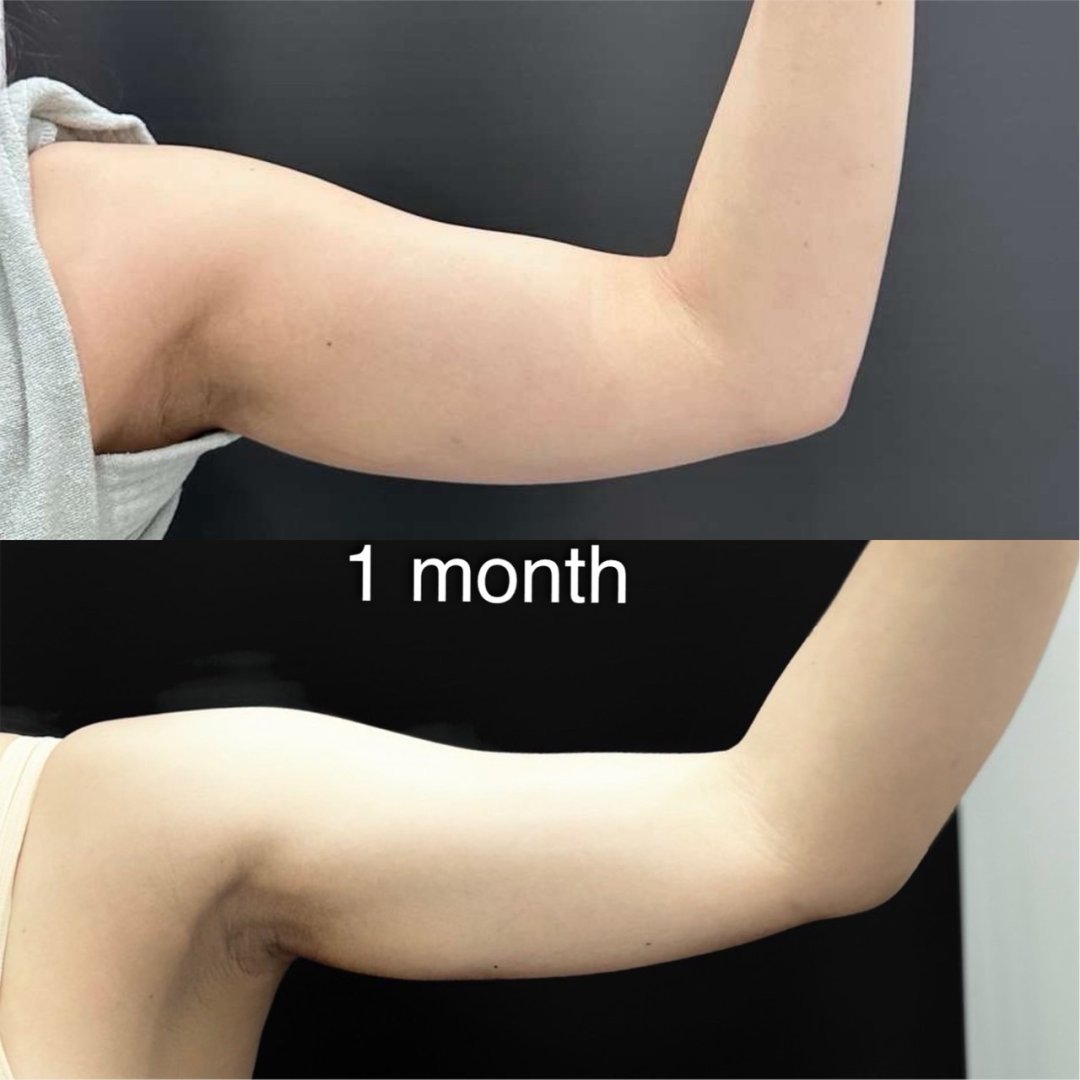 Endolift X Before After Result 6