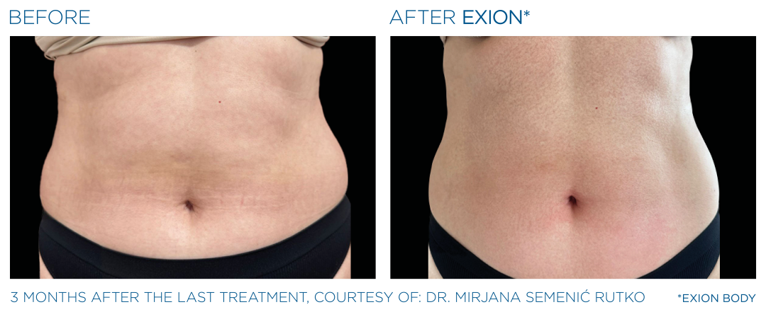 EXION Abdomen Treatment Before After