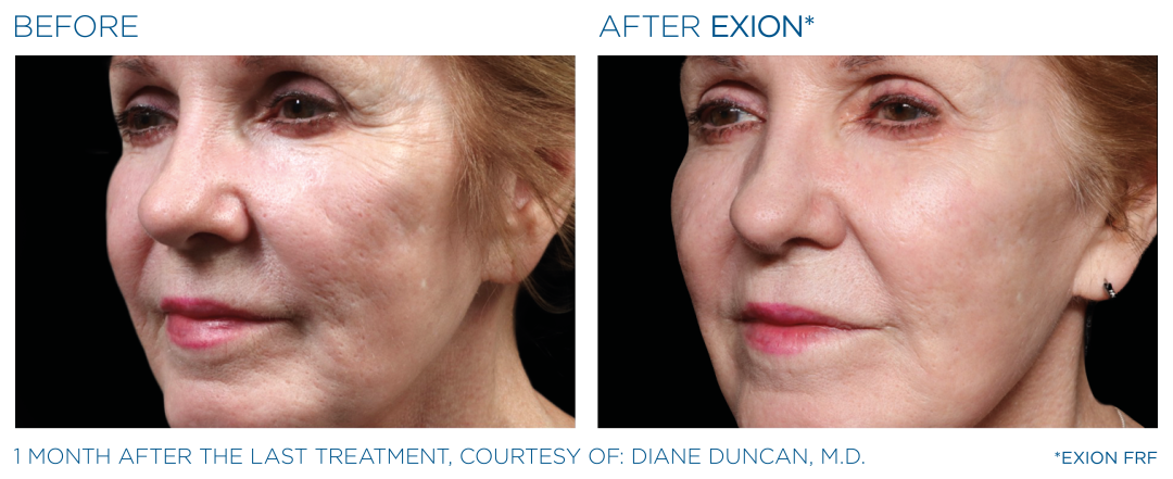 EXION Cheek Treatment Before After