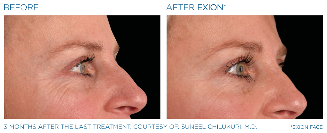 EXION Eye Treatment Before After