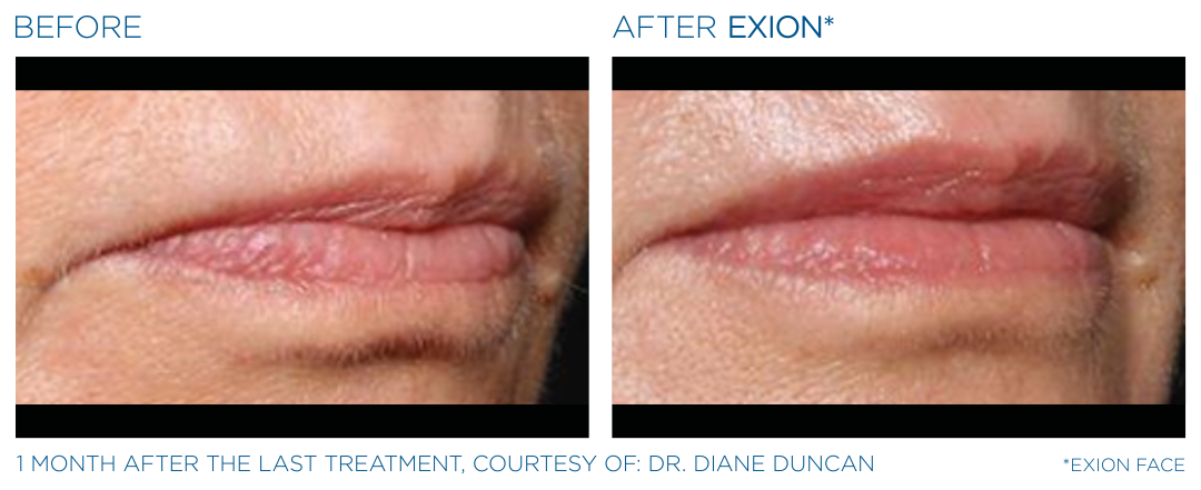 EXION Mouth Area Before After