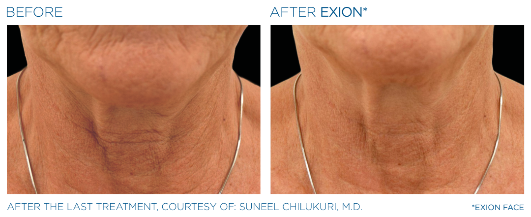 EXION Neck Treatment Before After