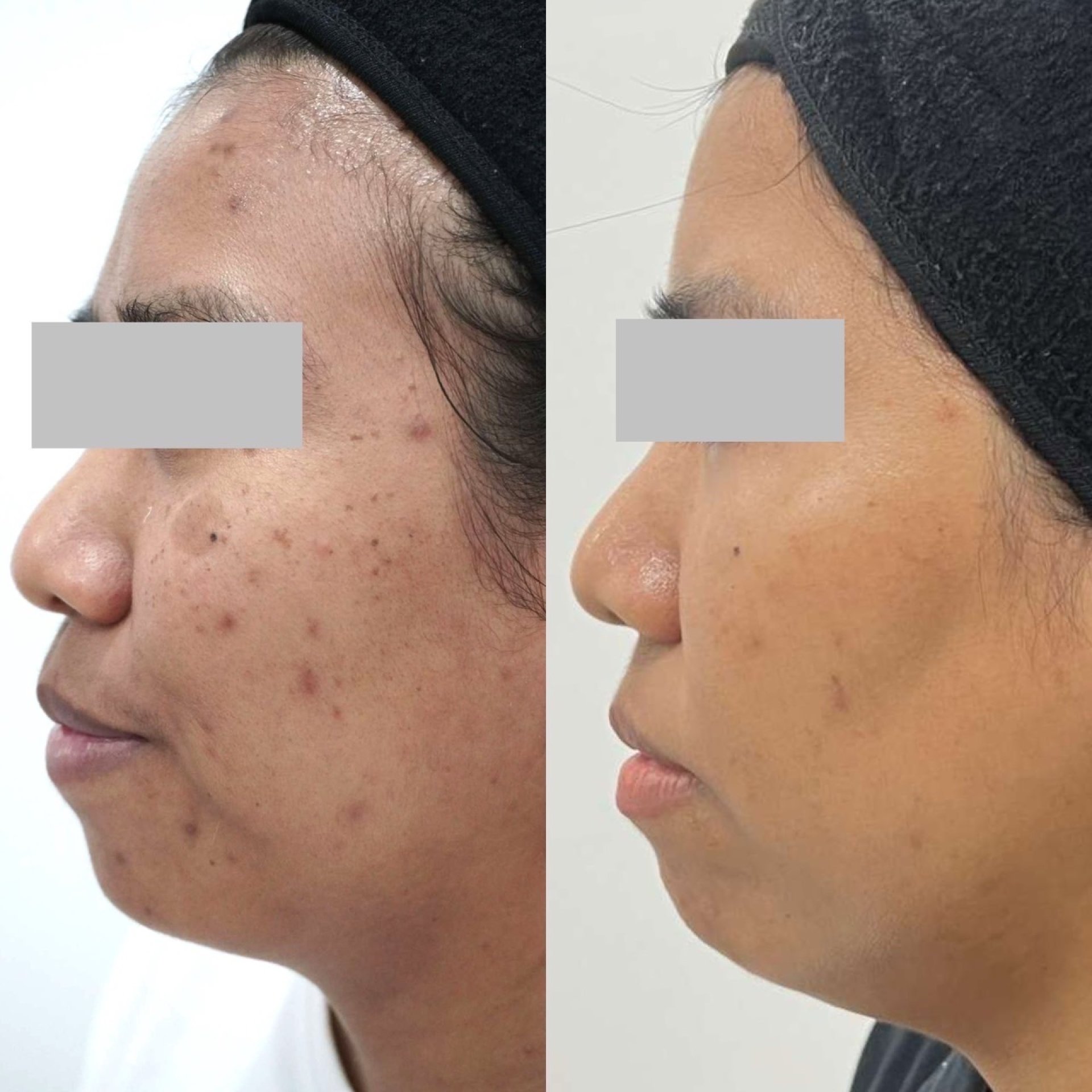 Picosecond laser treatment for pigmentation at Dr. Pang Skin Clinic