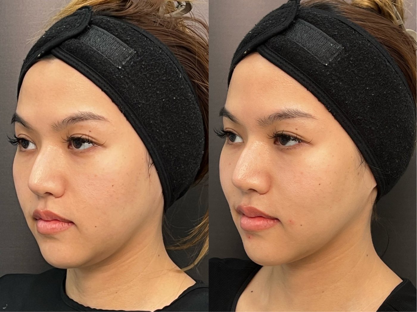 Pigmentation treatment before and after result at Dr. Pang Skin Clinic
