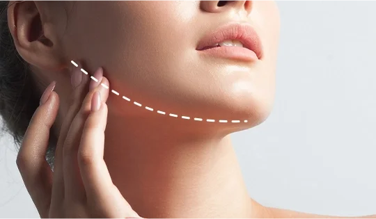 Filler Treatment Areas - Face and Neck