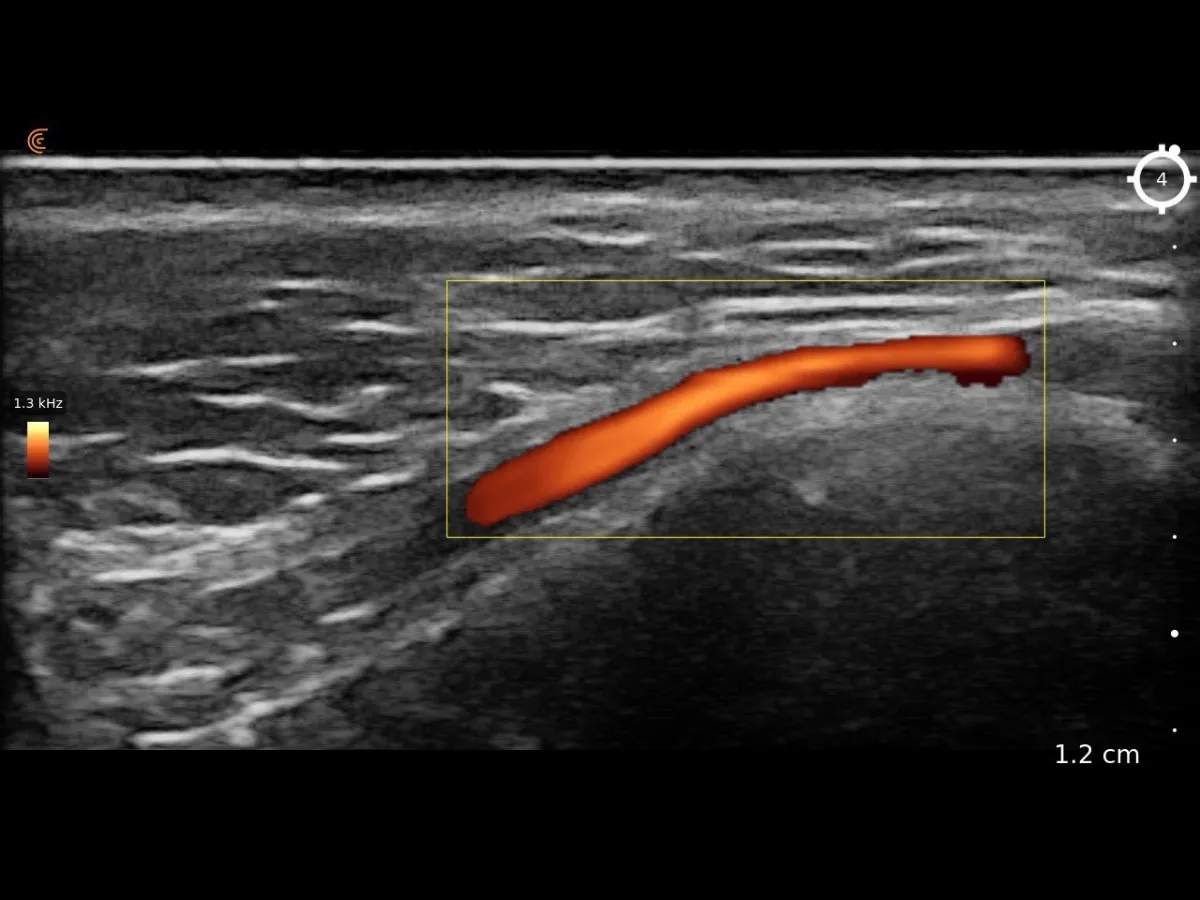 High-resolution ultrasound scan result showing skin tissue layers