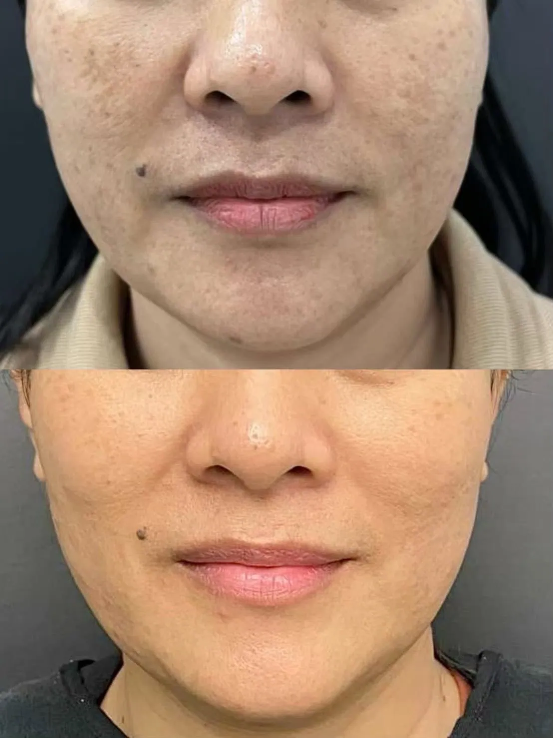 glutathione mesotherapy for melasma Skin Mesotherapy: Whitening Cocktail for Melasma & Fat Lysis