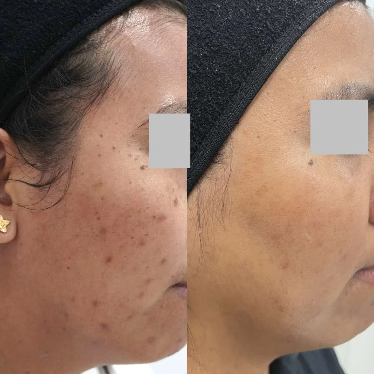 Skin Mesotherapy: Whitening Cocktail for Melasma & Fat Lysis Skin Mesotherapy: Whitening Cocktail for Melasma & Fat Lysis