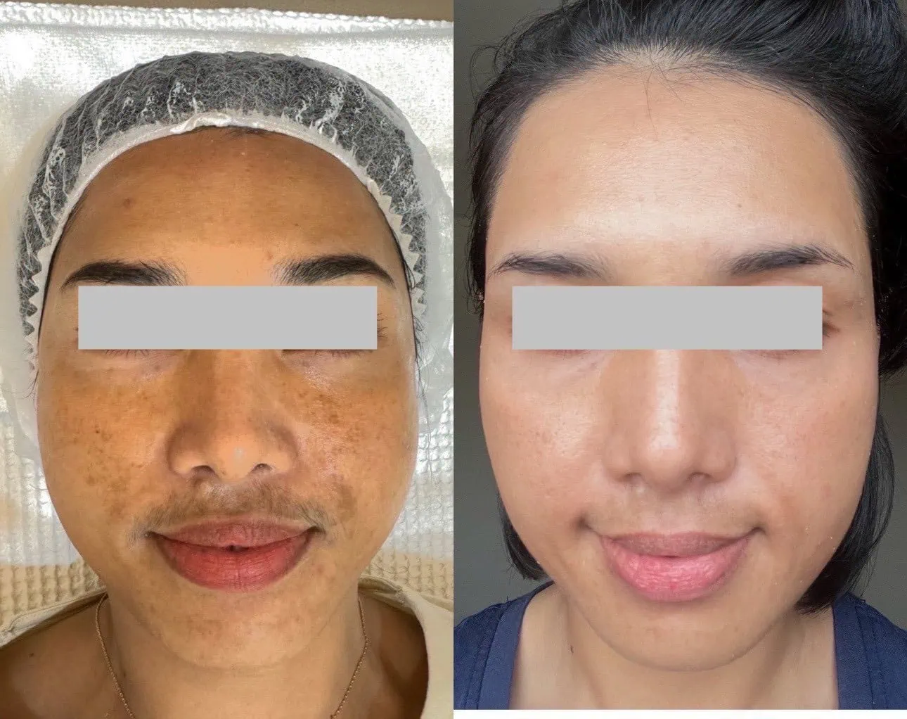 Skin Mesotherapy: Whitening Cocktail for Melasma & Fat Lysis