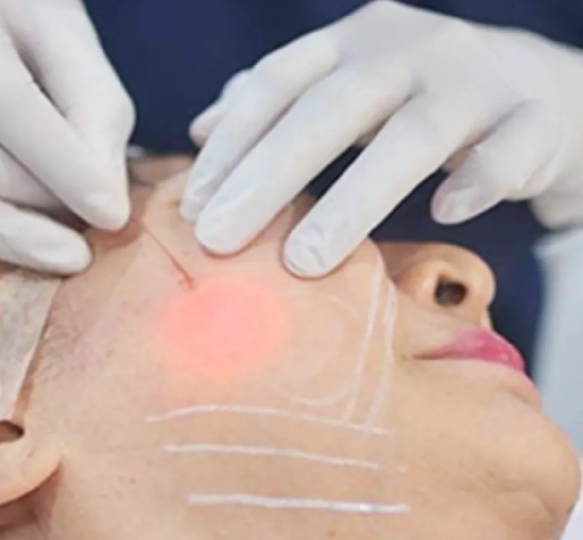 Endolift X 1470 nm diode laser treatment in progress — fine optical fiber being delivered beneath the skin during a non-surgical face lifting and fat reduction session at Dr. Pang Skin Clinic Bangkok