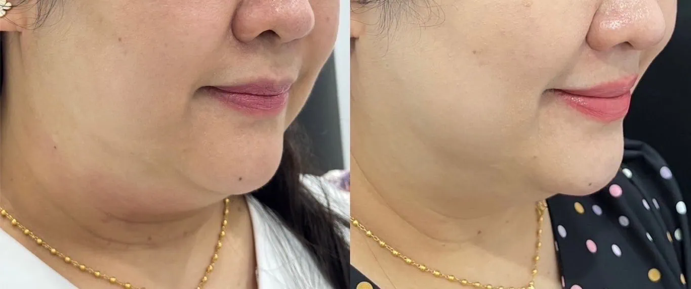 Fat Lysis Before & After 1