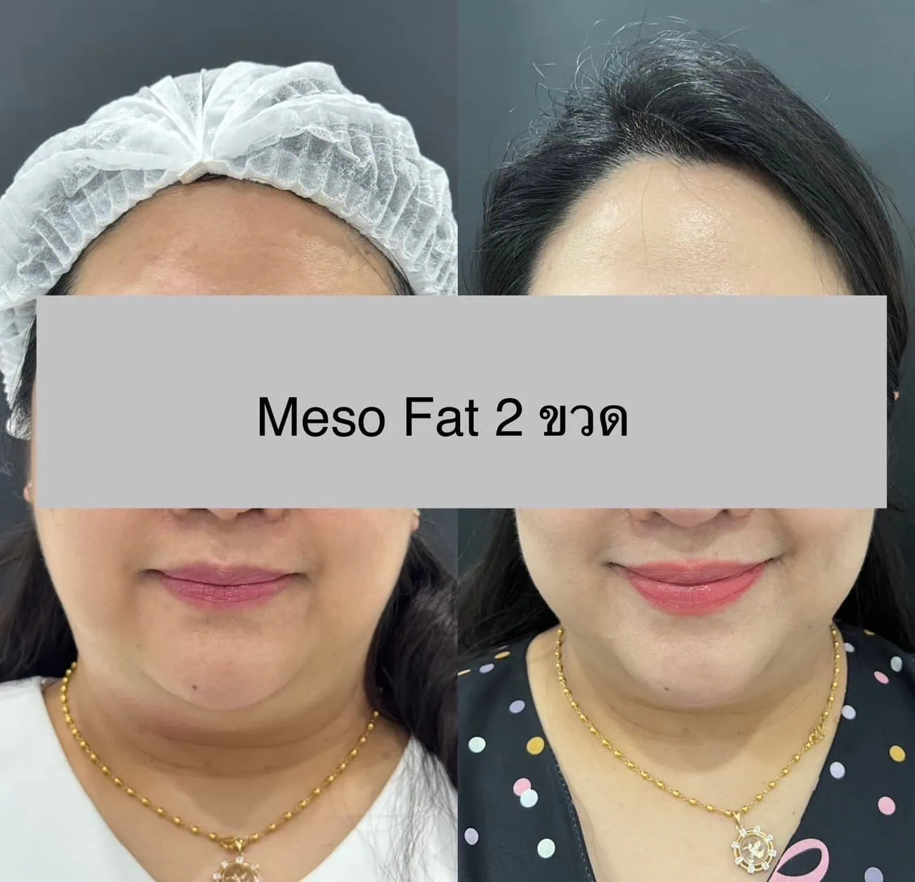 Fat Lysis Before & After 2