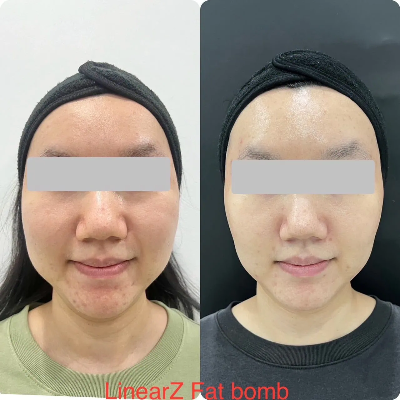 Fat Lysis Before & After 3