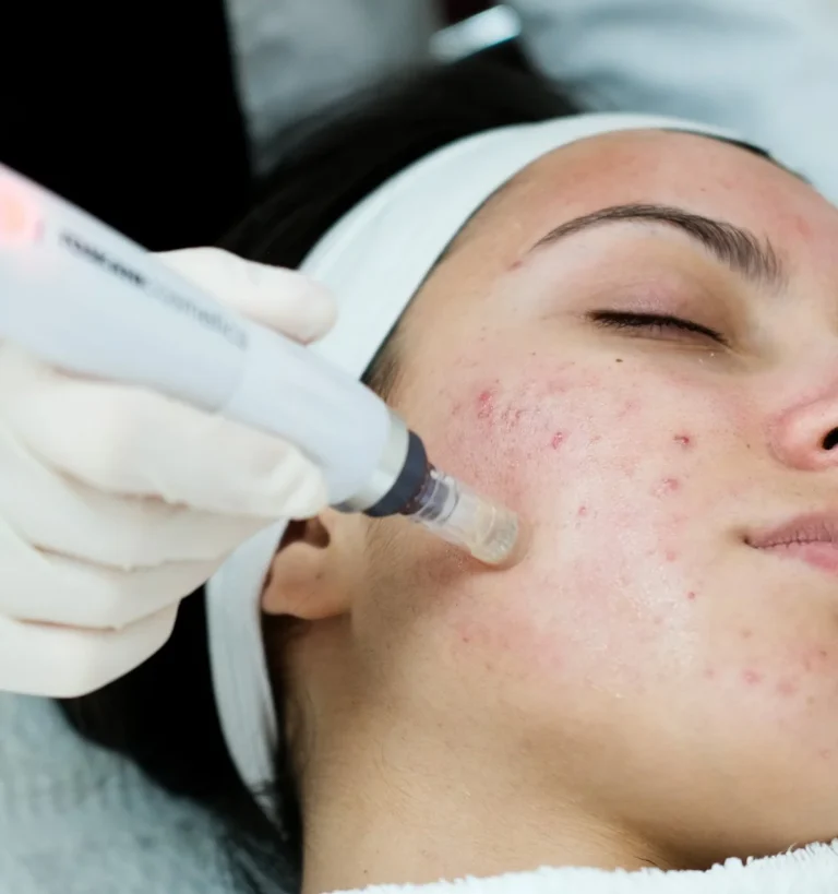 Comprehensive Acne and Scar Treatment