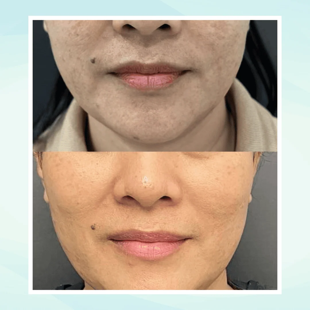 Pigmentation before and after result - pico laser treatment at Dr. Pang Skin Clinic