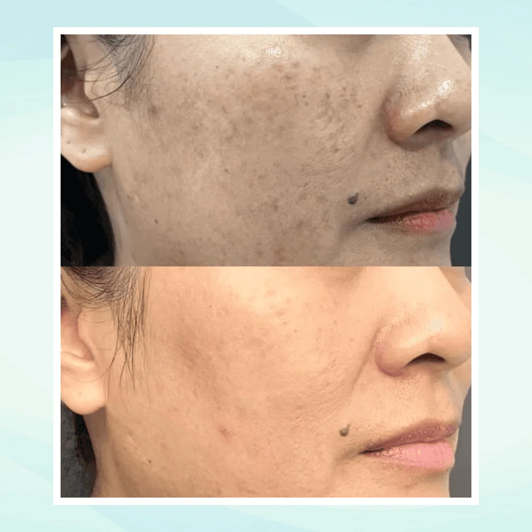 Pigmentation before and after result - pico laser treatment at Dr. Pang Skin Clinic