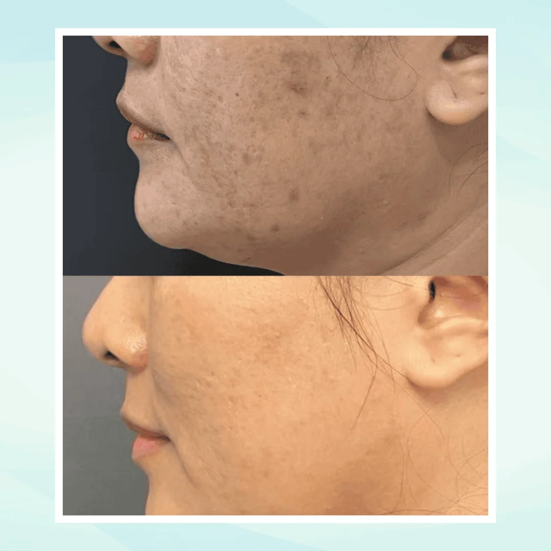 Pigmentation before and after result - pico laser treatment at Dr. Pang Skin Clinic