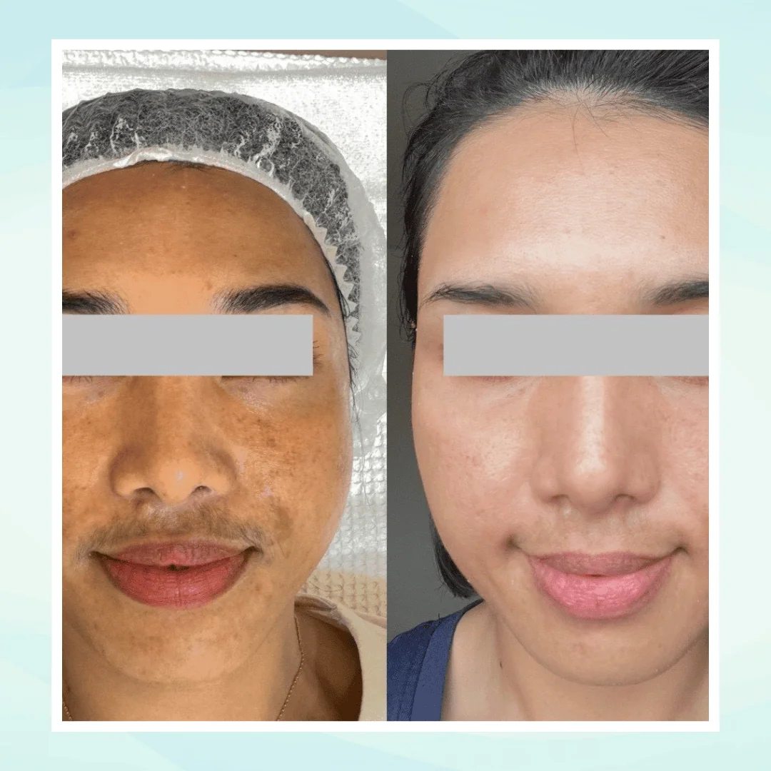 Pigmentation before and after result - pico laser treatment at Dr. Pang Skin Clinic