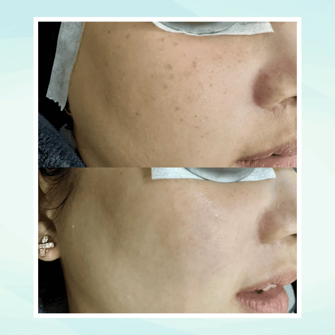 Pigmentation before and after result - pico laser treatment at Dr. Pang Skin Clinic