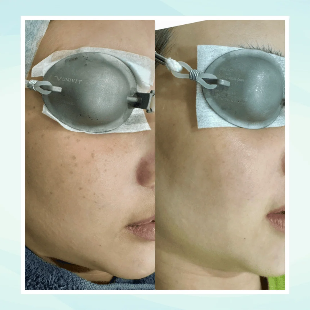 Pigmentation before and after result - pico laser treatment at Dr. Pang Skin Clinic