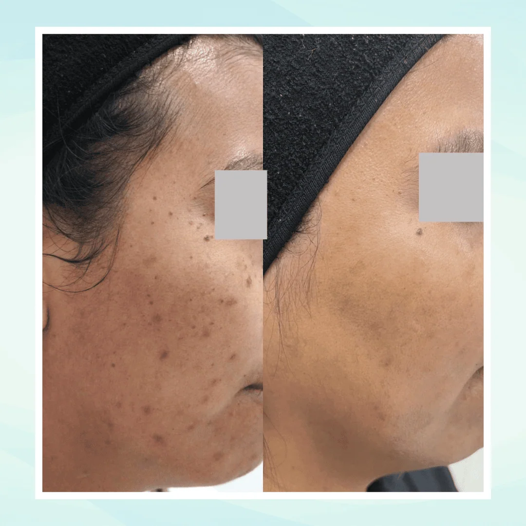 Pigmentation before and after result - pico laser treatment at Dr. Pang Skin Clinic