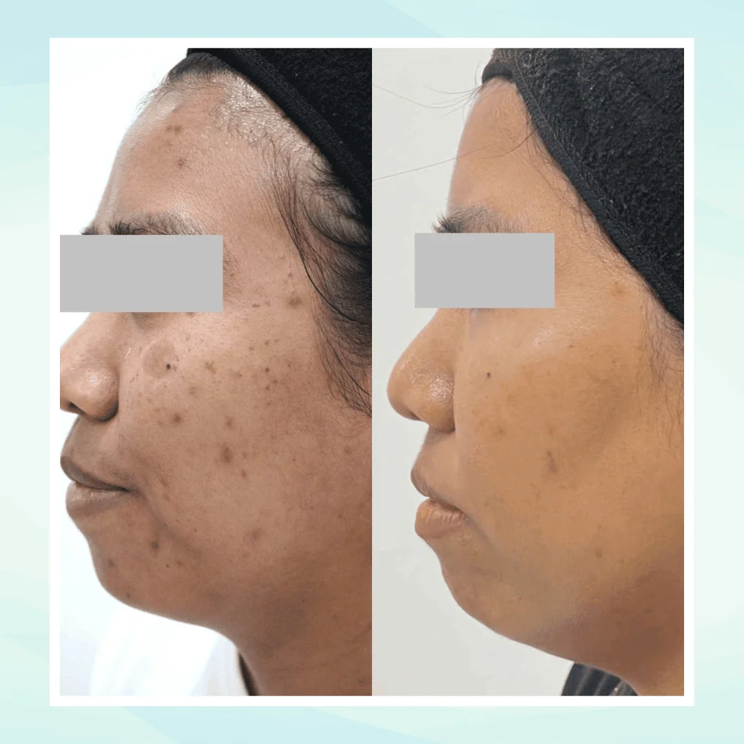 Pigmentation before and after result - pico laser treatment at Dr. Pang Skin Clinic