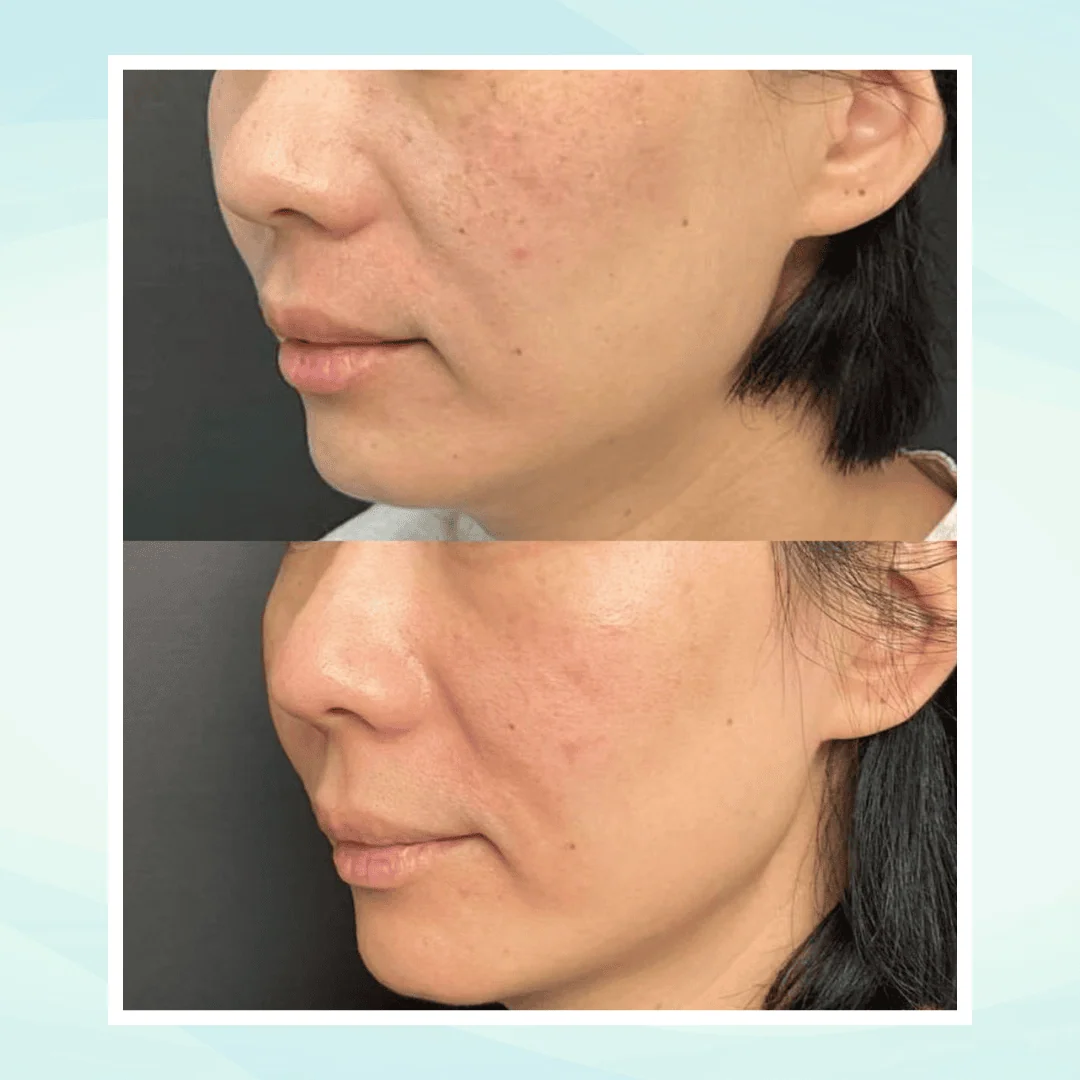 Pigmentation before and after result - pico laser treatment at Dr. Pang Skin Clinic