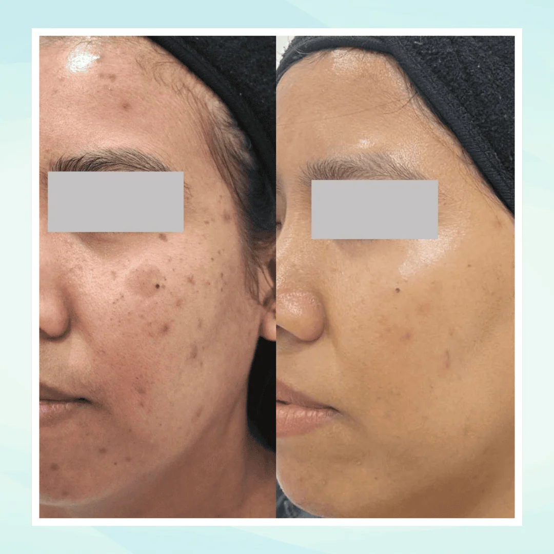 Pigmentation before and after result - pico laser treatment at Dr. Pang Skin Clinic