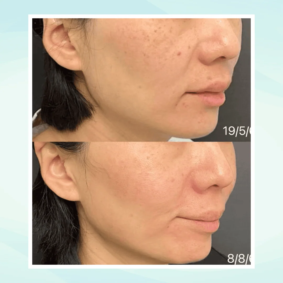 Pigmentation before and after result - pico laser treatment at Dr. Pang Skin Clinic