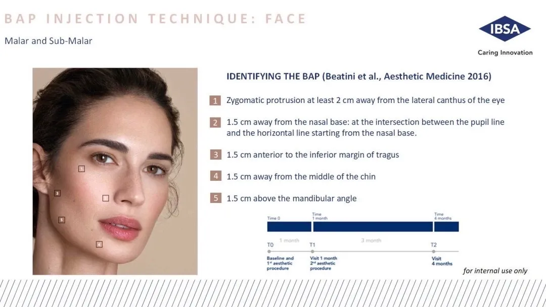 Profhilo BAP injection technique with 5 points on the face for safety and even spread
