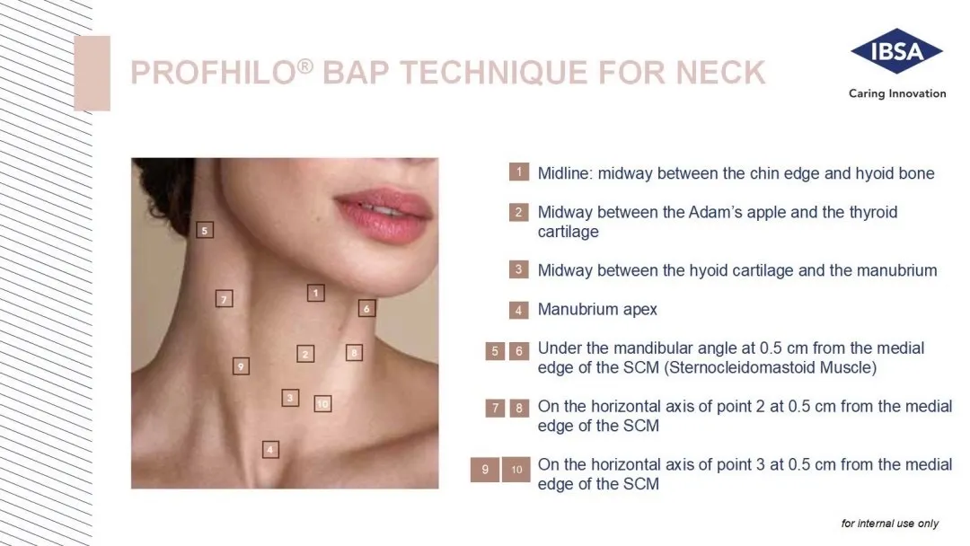 Profhilo BAP injection technique with 10 points on the neck, placed safely away from major vessels and nerves