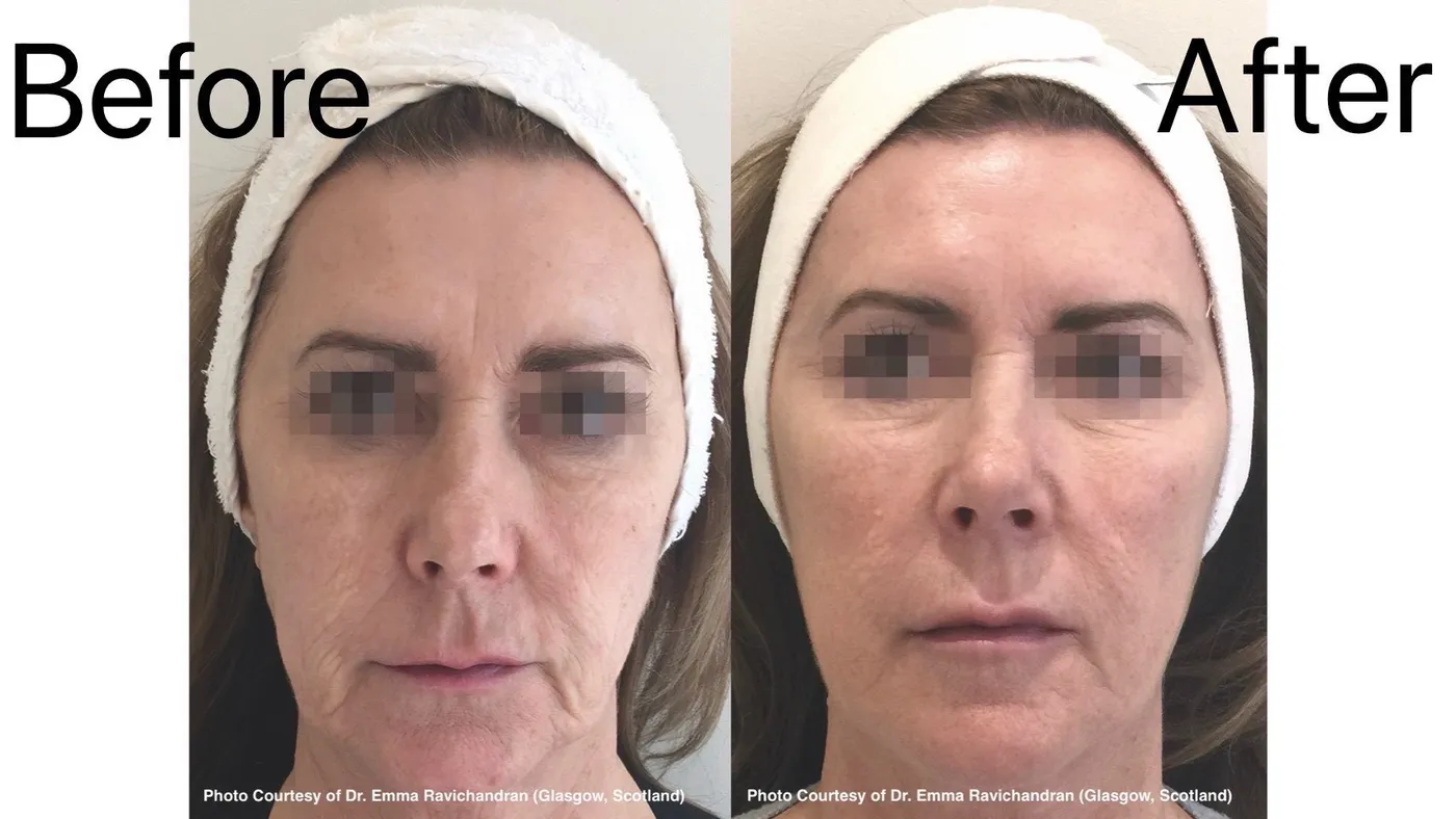 Before and after Profhilo on the face, showing firmer skin with reduced lines and laxity