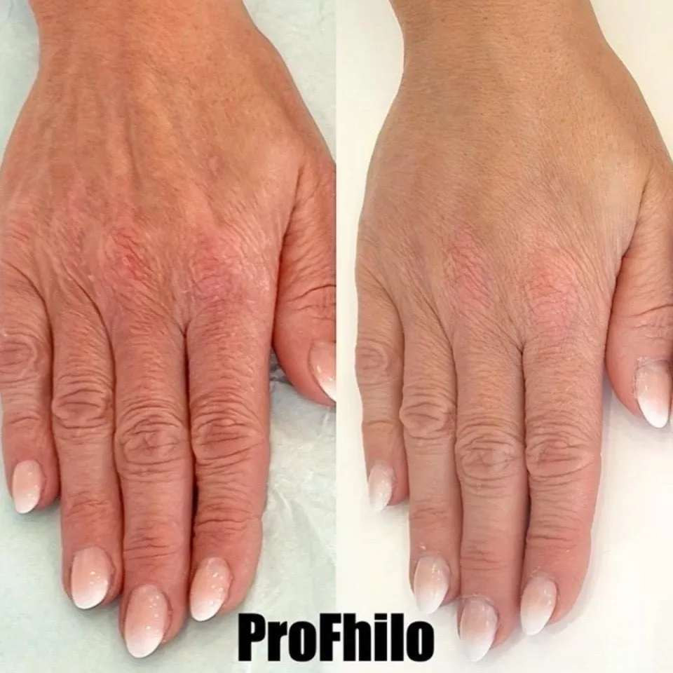 Before and after Profhilo on the back of the hands, showing firmer, more hydrated and younger-looking skin