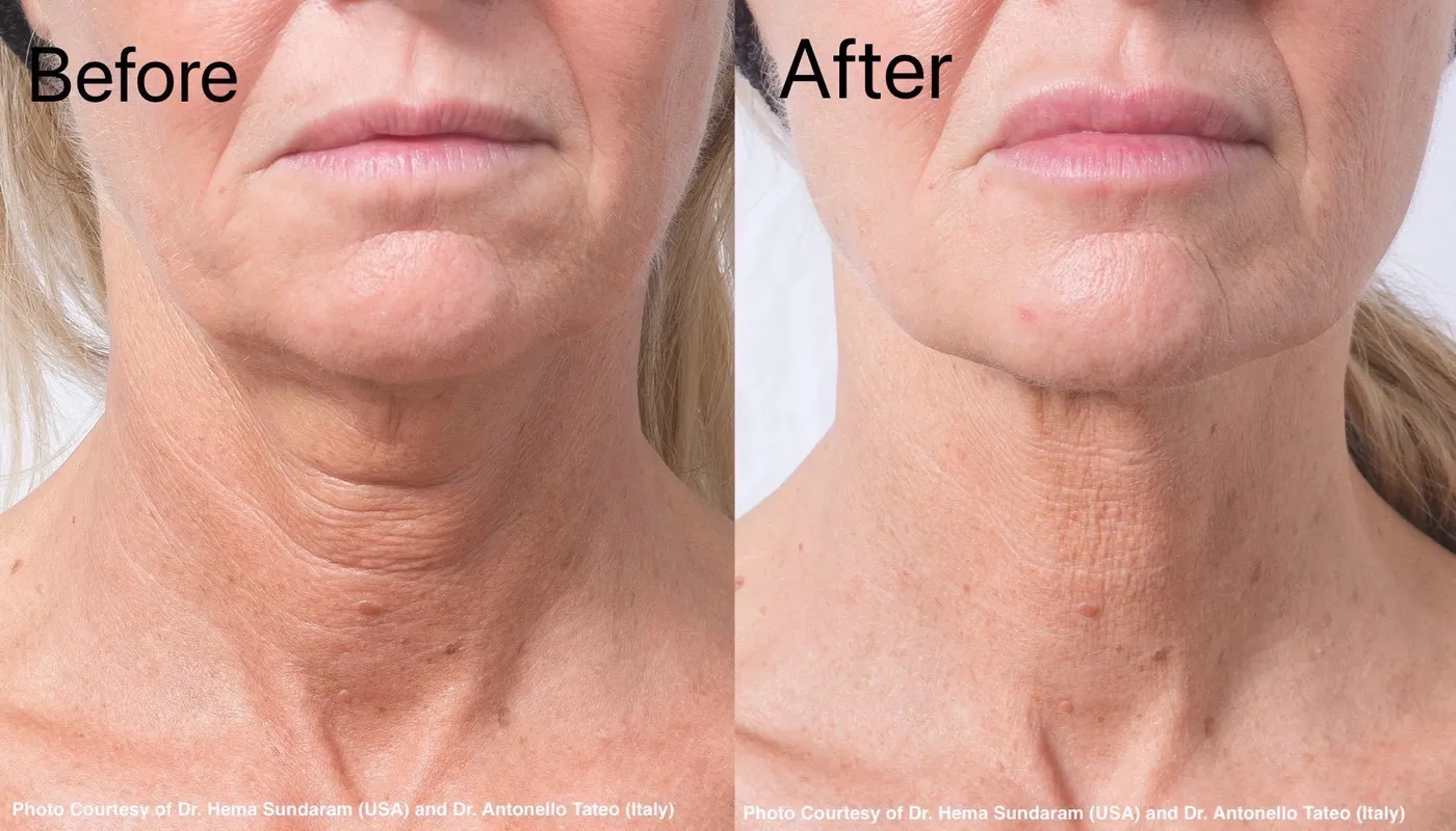 Before and after Profhilo on the neck, showing visibly smoother and firmer skin